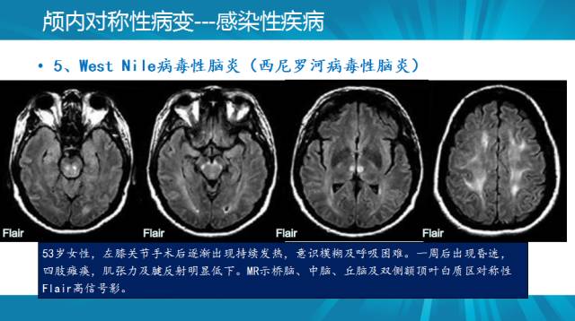【PPT】颅内对称性病变汇总