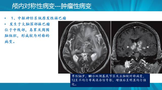 【PPT】颅内对称性病变汇总