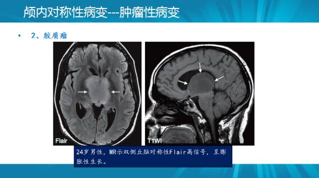 【PPT】颅内对称性病变汇总