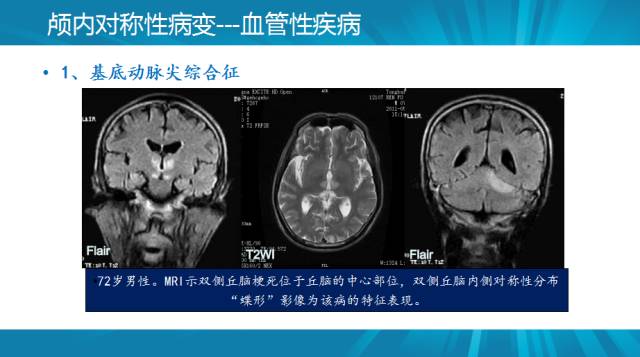 【PPT】颅内对称性病变汇总