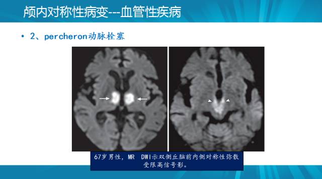【PPT】颅内对称性病变汇总