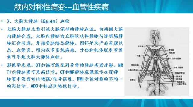 【PPT】颅内对称性病变汇总