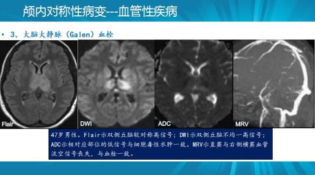 【PPT】颅内对称性病变汇总