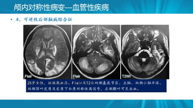 【PPT】颅内对称性病变汇总