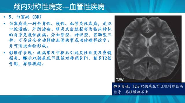 【PPT】颅内对称性病变汇总