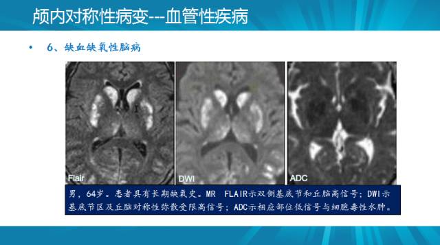 【PPT】颅内对称性病变汇总