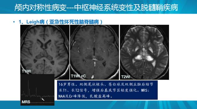 【PPT】颅内对称性病变汇总