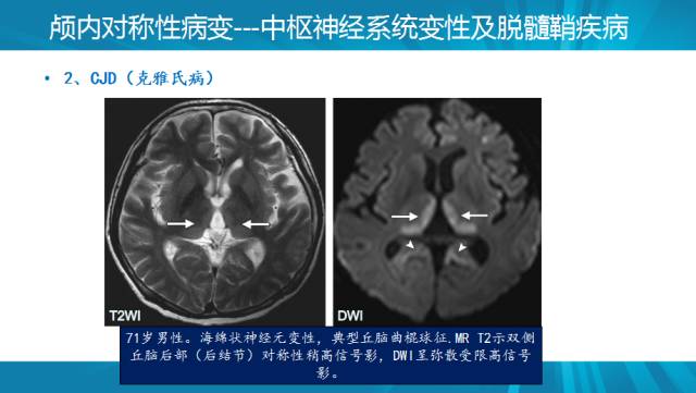 【PPT】颅内对称性病变汇总