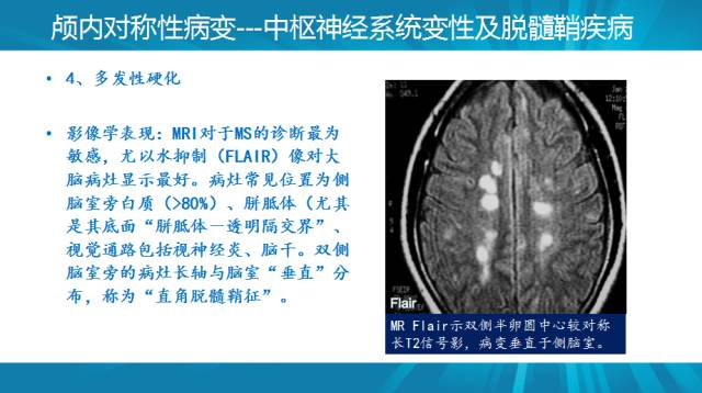 【PPT】颅内对称性病变汇总