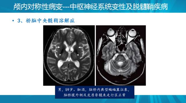 【PPT】颅内对称性病变汇总