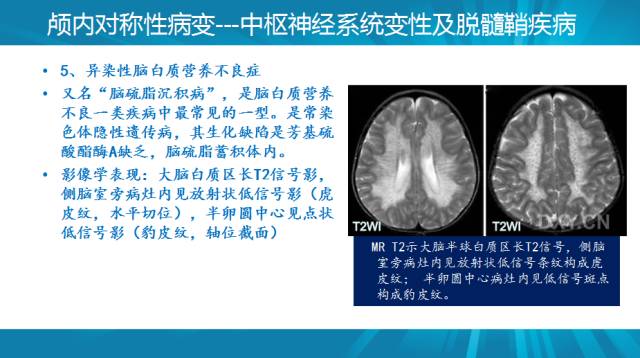 【PPT】颅内对称性病变汇总