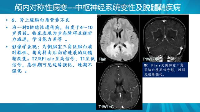 【PPT】颅内对称性病变汇总