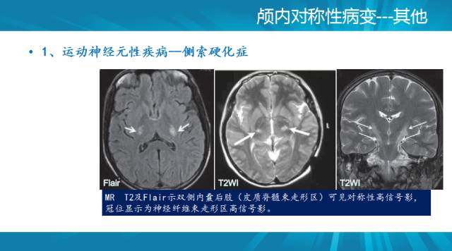 【PPT】颅内对称性病变汇总