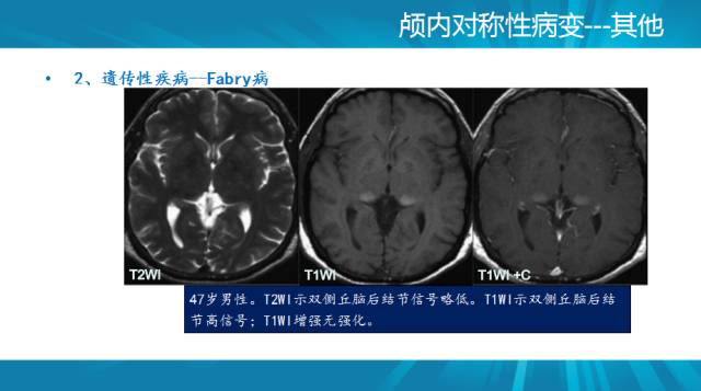 【PPT】颅内对称性病变汇总