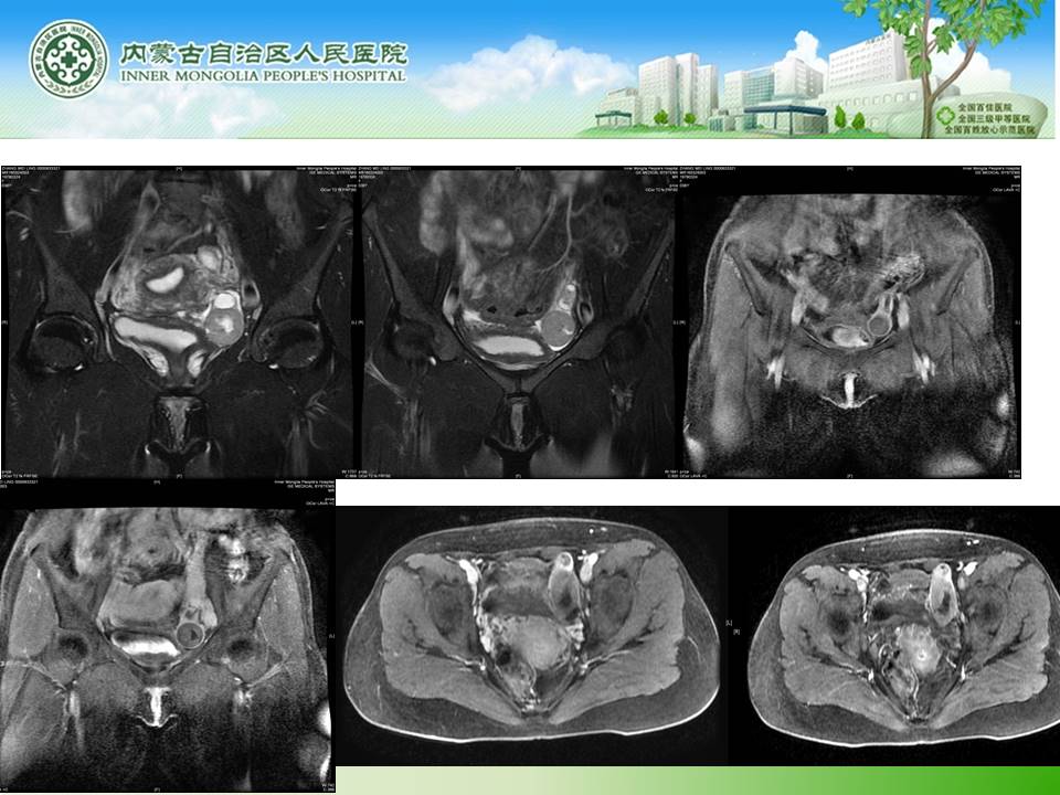 【病例】输卵管癌1例MR
