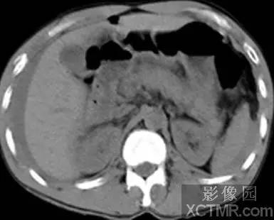【病例】急性腹膜炎1例CT 【病例】急性腹膜炎1例CT