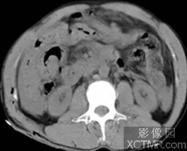 【病例】急性腹膜炎1例CT