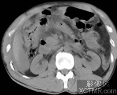 【病例】急性腹膜炎1例CT 【病例】急性腹膜炎1例CT