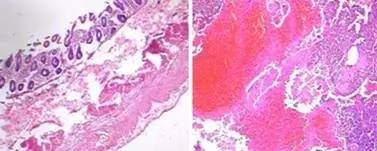 【病例】急性腹膜炎1例CT 【病例】急性腹膜炎1例CT