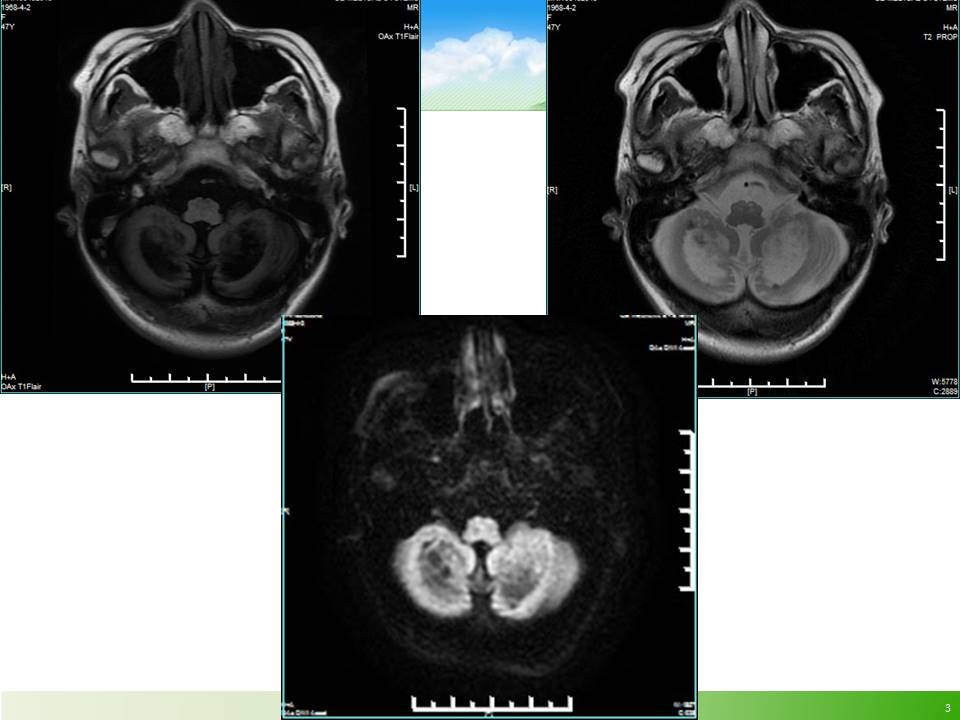 【病例】脑肌腱黄瘤病1例MR