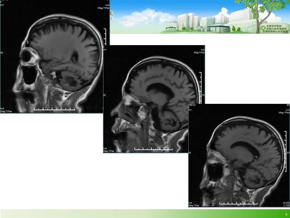 【病例】脑肌腱黄瘤病1例MR