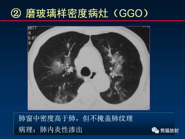 【PPT】肺曲霉菌病：放射科医生如何应对