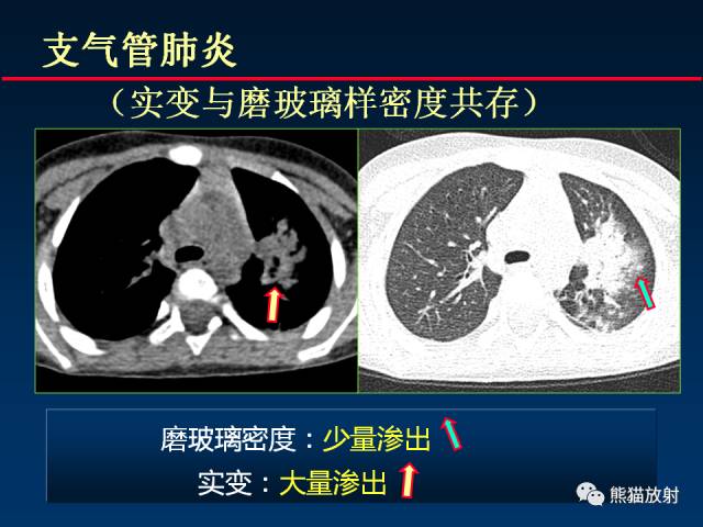 【PPT】肺曲霉菌病：放射科医生如何应对