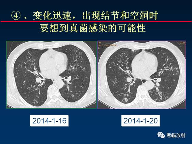 【PPT】肺曲霉菌病：放射科医生如何应对