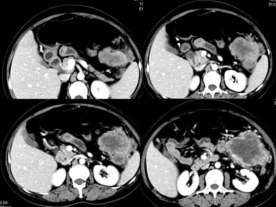 【病例】腹腔肉瘤伴多发转移1例CT