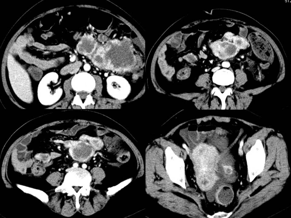 【病例】腹腔肉瘤伴多发转移1例CT