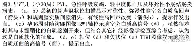 新生儿缺氧缺血性脑病多模态影像学表现 新生儿缺氧缺血性脑病多模态影像学表现