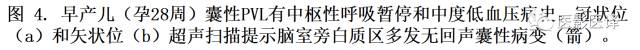 新生儿缺氧缺血性脑病多模态影像学表现 新生儿缺氧缺血性脑病多模态影像学表现