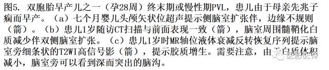 新生儿缺氧缺血性脑病多模态影像学表现 新生儿缺氧缺血性脑病多模态影像学表现