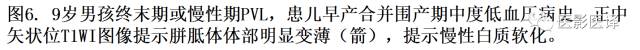 新生儿缺氧缺血性脑病多模态影像学表现 新生儿缺氧缺血性脑病多模态影像学表现