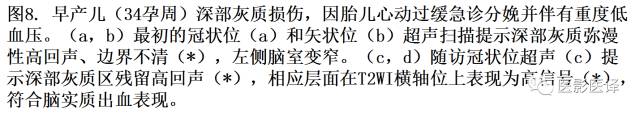 新生儿缺氧缺血性脑病多模态影像学表现 新生儿缺氧缺血性脑病多模态影像学表现