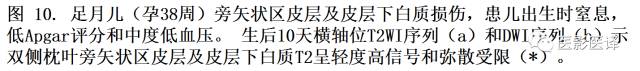 新生儿缺氧缺血性脑病多模态影像学表现 新生儿缺氧缺血性脑病多模态影像学表现