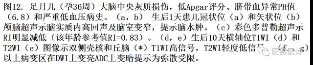 新生儿缺氧缺血性脑病多模态影像学表现 新生儿缺氧缺血性脑病多模态影像学表现