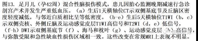新生儿缺氧缺血性脑病多模态影像学表现 新生儿缺氧缺血性脑病多模态影像学表现