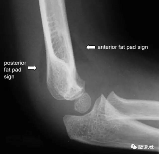 急诊非常重要的肘关节“脂肪垫征”,不要假装没看见 急诊非常重要的肘关节“脂肪垫征”,不要假装没看见