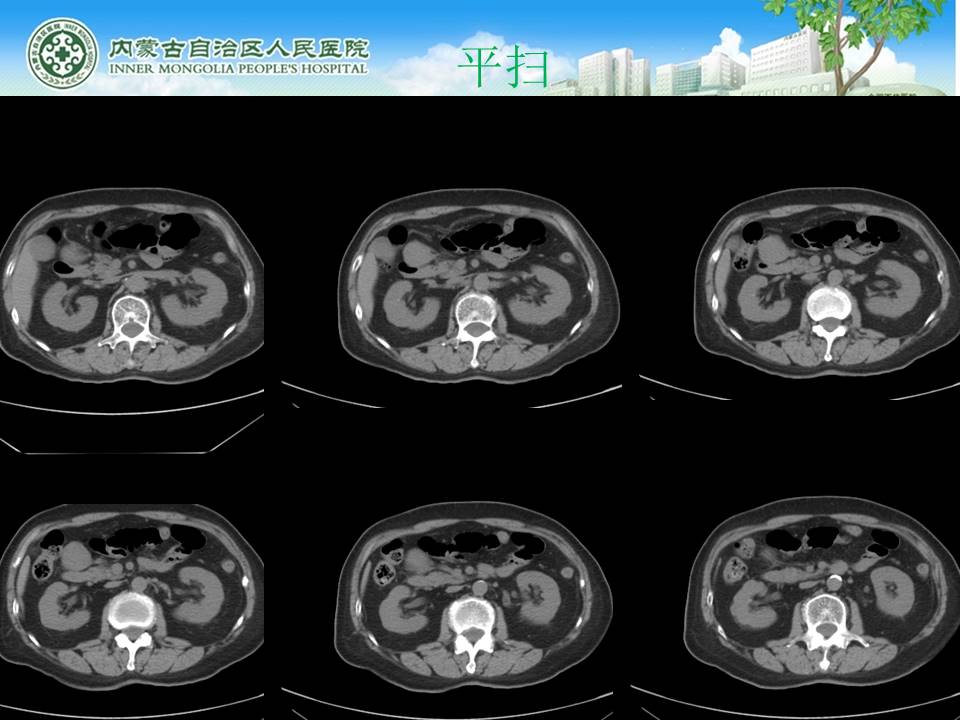 【病例】腹腔副神经节瘤1例CT