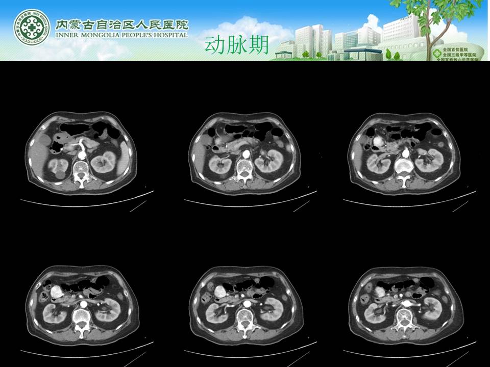 【病例】腹腔副神经节瘤1例CT