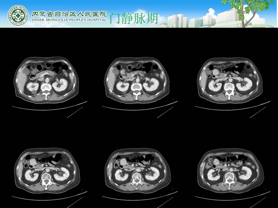 【病例】腹腔副神经节瘤1例CT