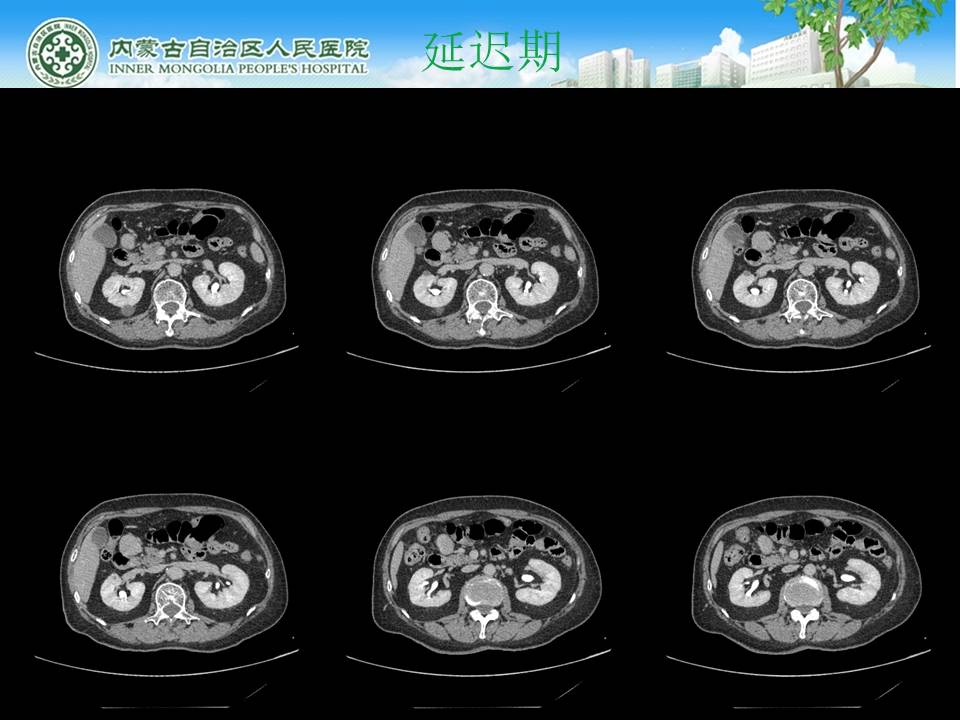 【病例】腹腔副神经节瘤1例CT