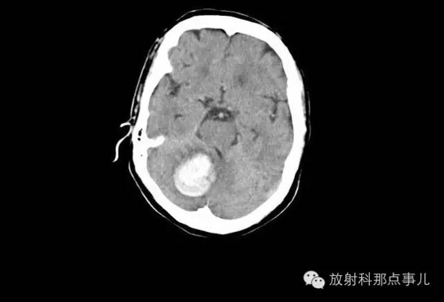 非增强颅脑CT 那些不可错过的细节