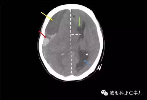 非增强颅脑CT 那些不可错过的细节