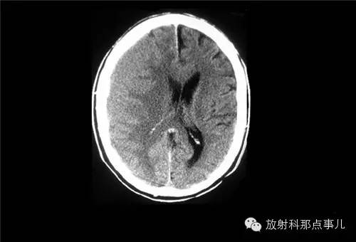 非增强颅脑CT 那些不可错过的细节