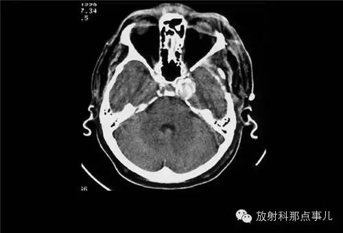 非增强颅脑CT 那些不可错过的细节