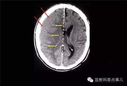 非增强颅脑CT 那些不可错过的细节