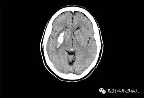 非增强颅脑CT 那些不可错过的细节