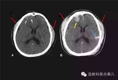 非增强颅脑CT 那些不可错过的细节
